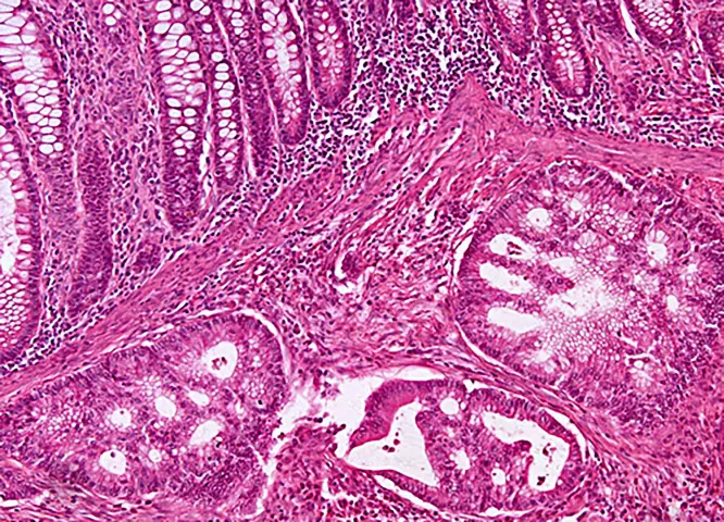 Gewebedarstellung im Mikroskop, Dr. med. Hölzl und Dr. med. Eisenlohr und Dr. med. Assmann, Pathologie, Gastroenterologie im Josephinum