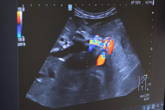 Ultraschall-Bild mit Farbdoppler, Gastroenterologie im Josephinum